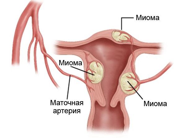 Лечение миомы матки: путь к здоровью и счастью