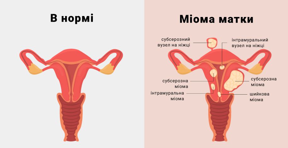 Лечение миомы матки: путь к здоровью и счастью